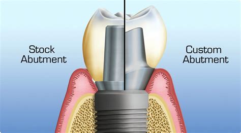 Procedure For Design Of Abutments