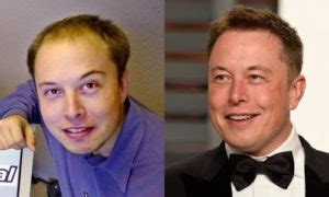 Elon musk hair before and after. Elon Musk Hair Transplant - Famous people hair ...