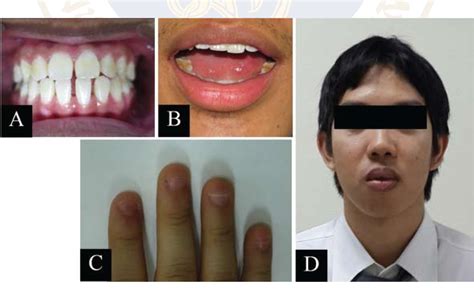 [pdf] prevalence of abnormal oral habits and its relation to malocclusion in dental patients of