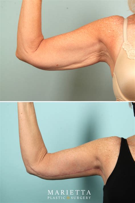 Arm Lift Before After Artofit