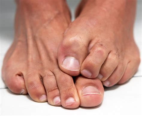 Non Drug Treatments For Toenail Fungus The New York Times