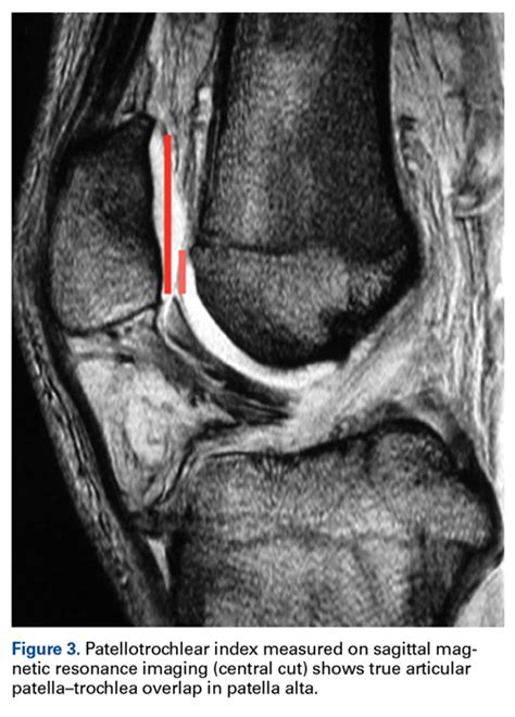 Patella Alta A Comprehensive Review Of Current Knowledge Mdedge Surgery