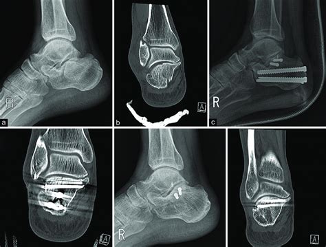 A Case Of A 60 Year Old Male Patient A Preoperative Radiograph Of