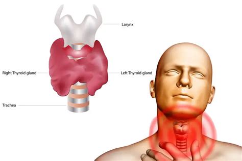 15 Diy Home Remedies For Goiter Wellnessguide