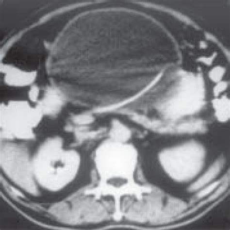 Contrast Enhanced Ct Scan Of Abdomen Axial View Shows A Large