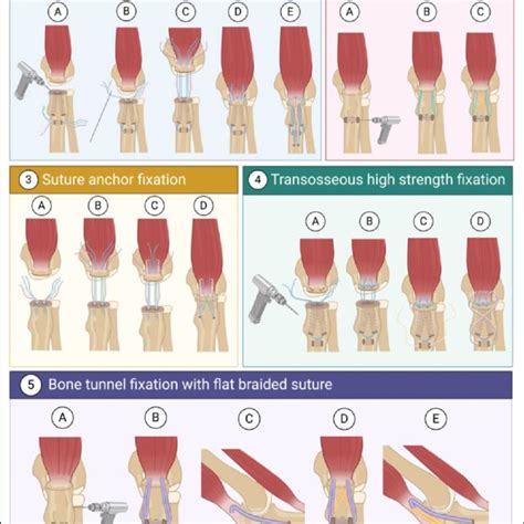 Five Methods Of Fixation For Displaced Olecranon Fractures Without The