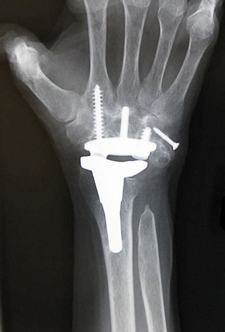 Arthritis Of The Wrist Orthopedic And Sports Medicine