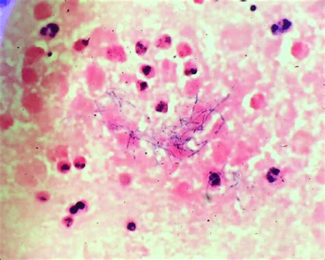 Gram Stain Of Right Pleural Effusion Beaded Branching Gram Positive