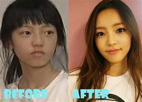 What Are Some K Pop Idols Before And After Plastic Surgery Pictures