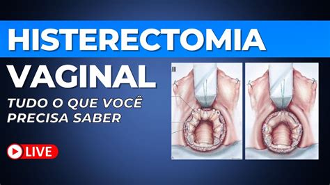 Histerectomia Vaginal tudo o que você precisa saber YouTube