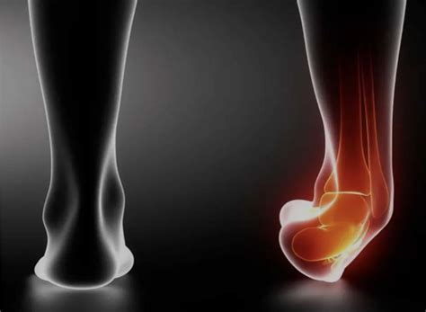 What Causes Chronic Ankle Instability Watsonia Podiatry