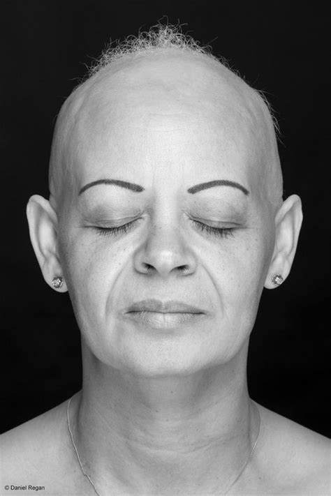 Powerful Photos Of People With Alopecia Prove Bald Is Beautiful Huffpost