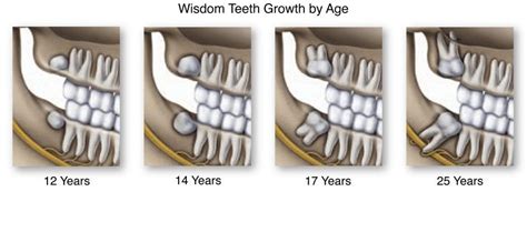 True Wisdom About Wisdom Teeth What You Should Know