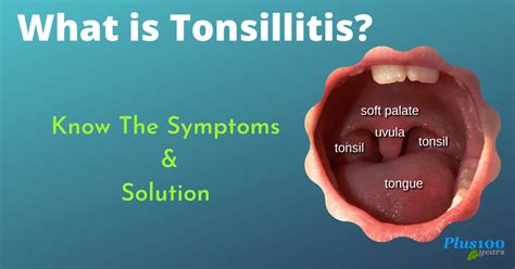What Is Tonsillitis Know The Symptoms And Solution
