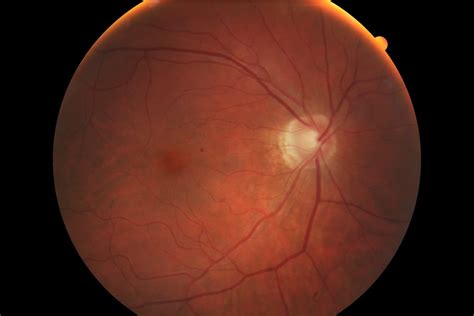 Types Of Vision Problems Sydney Eye Hospital Foundation