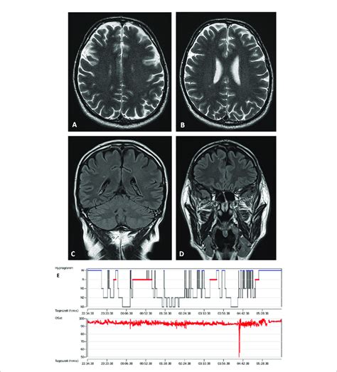 Brain Magnetic Resonance Imaging And Polysomnography Brain Magnetic Download Scientific