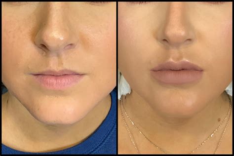 Lip Filler Before And After Bella Vi