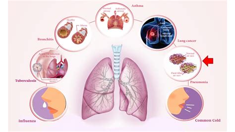 Science Respiratory Diseases Disorders Of Respiratory System