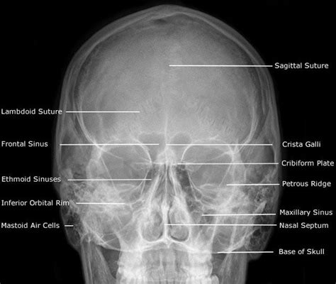 There may be other reasons for. Townes Skull X-ray | X-Ray | Pinterest | The skulls ...