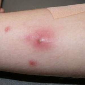 Very young children and elderly. mrsa look like