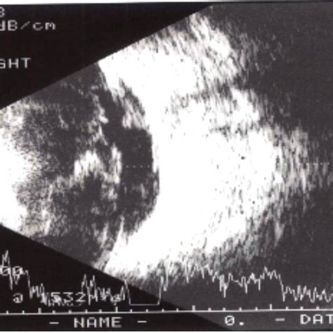 B Scan Ultrasound Image Of The Right Eye Showing Dispersed Opacities