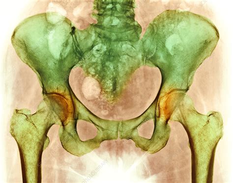 Osteoarthritis Of Hip Joints X Ray Stock Image M1100664 Science