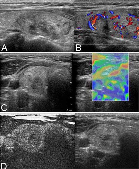 Frontiers Differentiation Of Thyroid Nodules Difficult To Diagnose