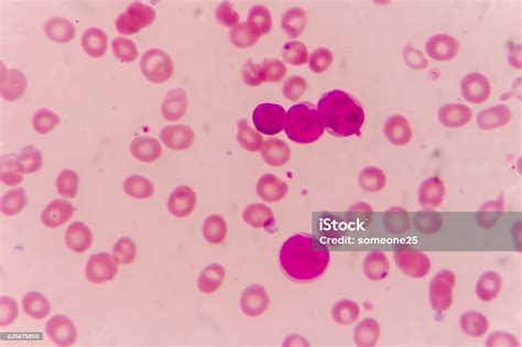 Blast Cells In Leukemia Stock Photo Download Image Now Acute Angle