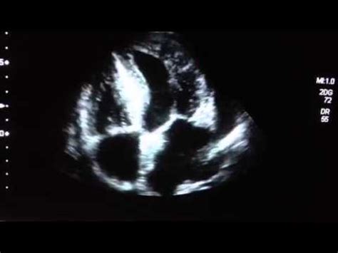 Miocardiopatía hipertrófica, pruebas complementarias, diagnóstico clínico, analítica, electrocardiograma, doppler tisular, resonancia magnética nuclear. Miocardiopatia Hipertrofica - YouTube