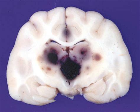 Photograph Of A Transversely Sectioned Formalin Fixed Brain From A
