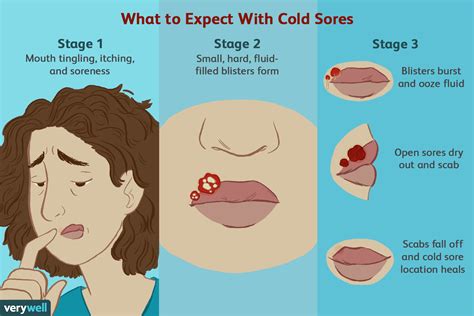 How To Remove A Mouth Ulcer Ways To Get Rid Of Sores Artofit