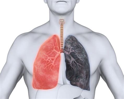 What Is Emphysema Facty Health