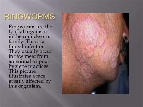 Roundworms Ascaris