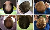 Pictures of Ziering Hair Restoration