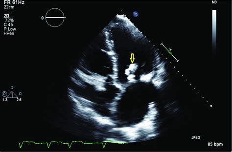 Mitral Valve Calcification