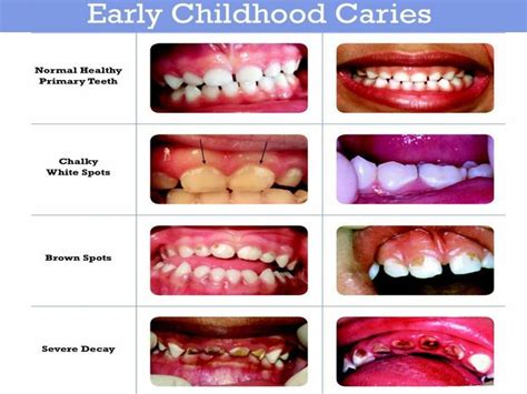 Image Result For Early Childhood Caries High Carb Foods Dental