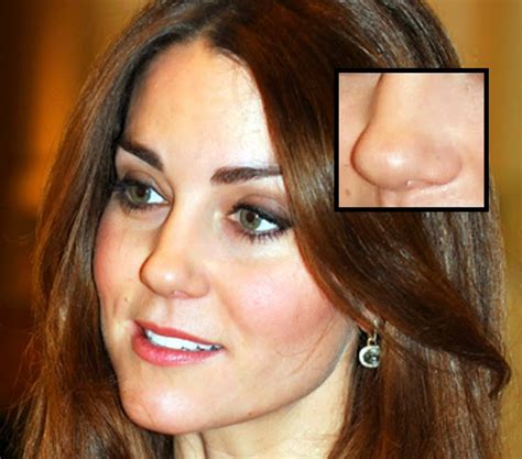 Celebrity Kate Middleton Had Plastic Surgery The Glitter