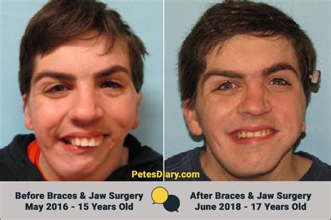 Braces Before And After Jaw Surgery Before And After