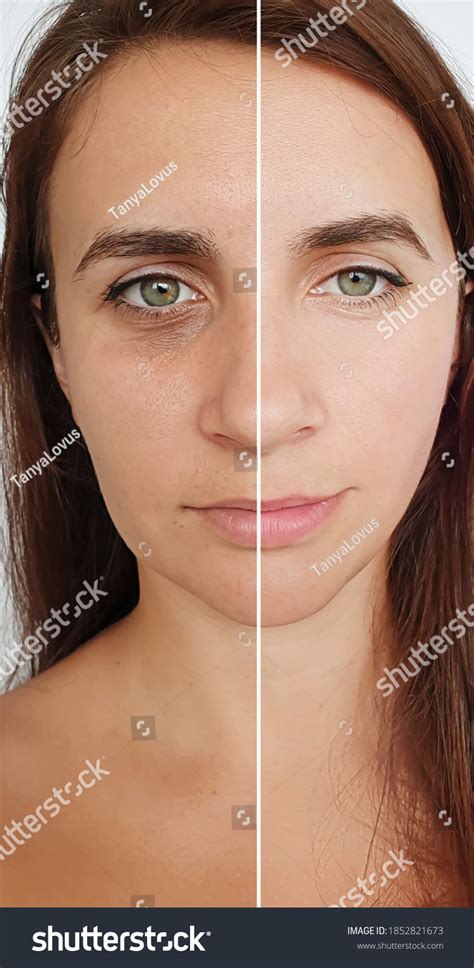 Woman Face Wrinkles Before After Treatment Stock Photo 1852821673