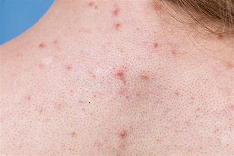 Acne Skin Texture Stock Images Download 1265 Royalty Free Photos