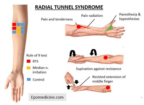 Radial Tunnel Syndrome Rts Anatomy And Clinical Examination My Xxx