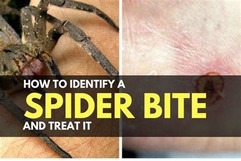 How To Identify A Spider Bite And Treat It Spider Bites Treating Spider Bites Identifying