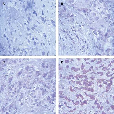 Immunoperoxidase Staining Of Bcl 2 Anti Apoptotic Protein On Sections