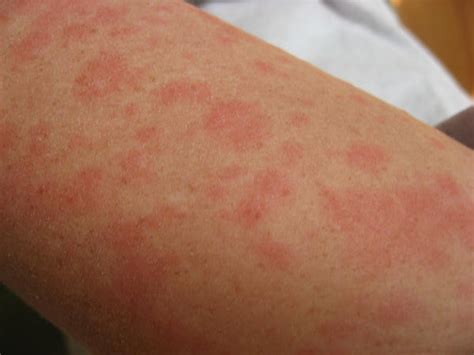 Pictures Of Skin Rashes