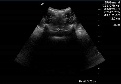 Obstetric Anesthesia Spinal Ultrasound Paramedian Transverse Lumbar