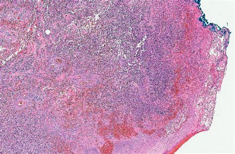Pathology Outlines Pyoderma Gangrenosum