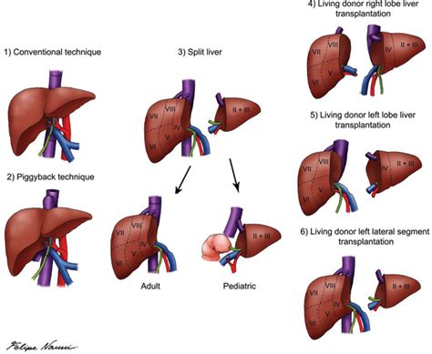 Pediatric Liver Transplantation Intechopen