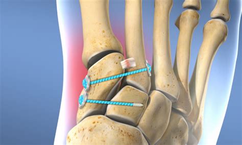 Lisfranc Midfoot Fracture Treatment In Pune Dr Chetan Oswal