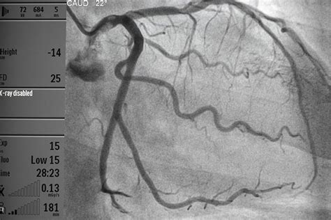 Angiography For Cardiac Arrest Survivors No Need To Rush Medpage Today