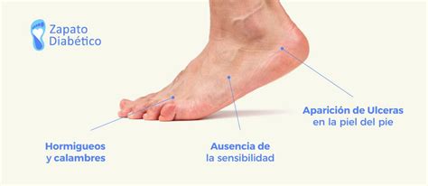 El Proceso De La Neuropatia En La Diabetes Zapato Diabético